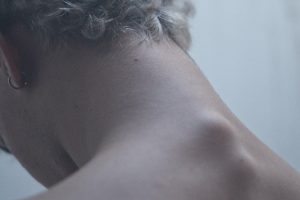 What is Cervical Disc Degeneration?